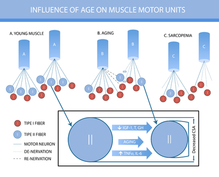 Sarcopenia